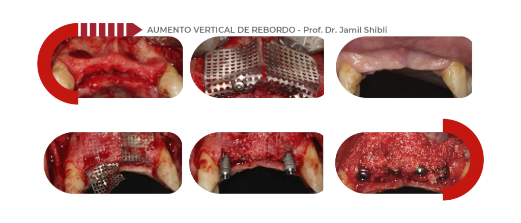 Aplicações clínicas Ti Mesh-Lock ®